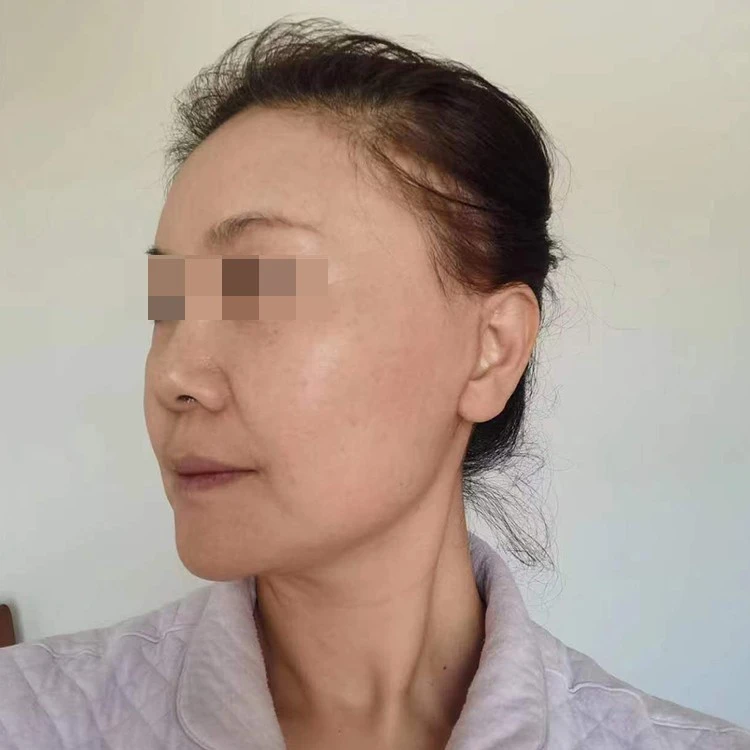 Nasolabial fold filler recovery period