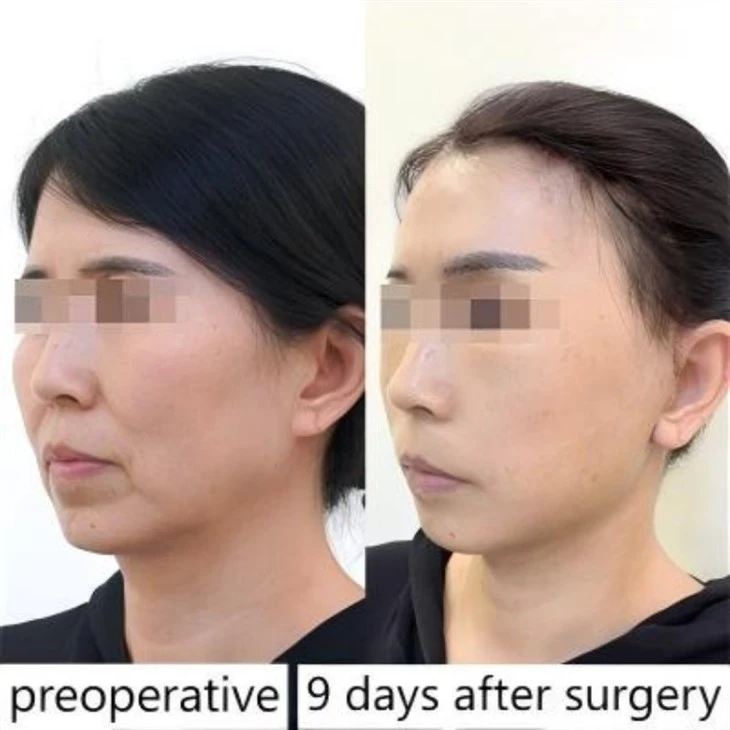 Nasolabial fold filler price