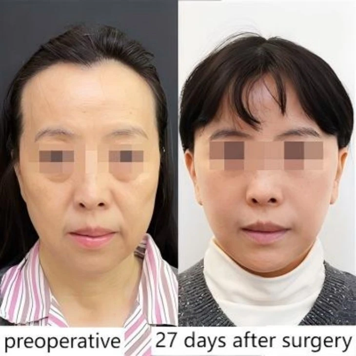 Facial Ptosis Treatment