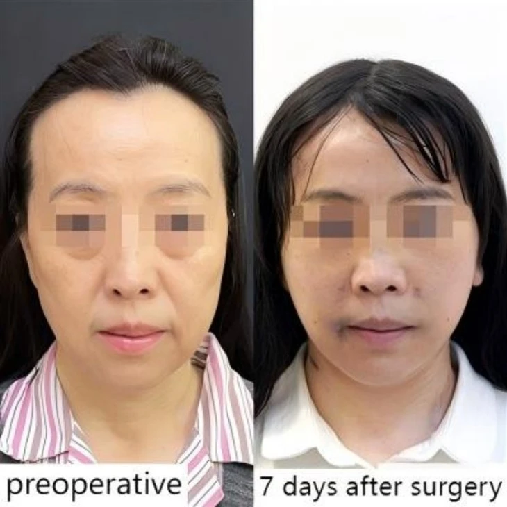 Facial Sagging Plastic Surgery