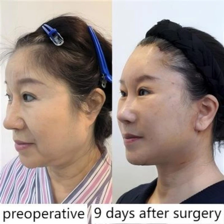 Lower face lift results