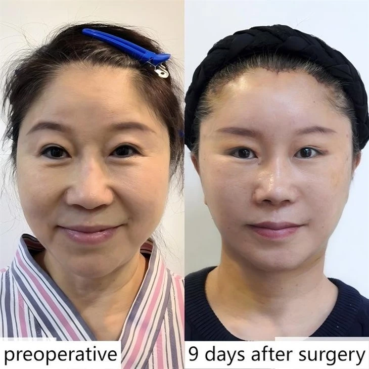 Lagere facelift