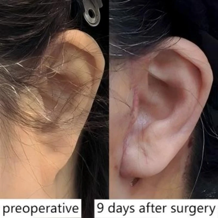 Lower Face Lift Recovery