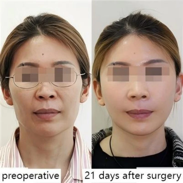 Jawline Reduction Surgery
