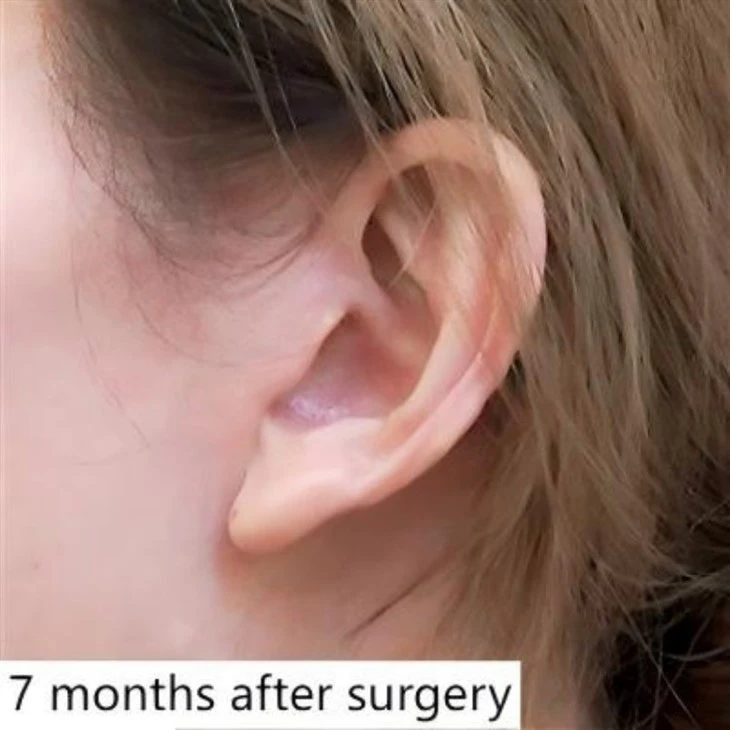 Jawline Reduction Surgery