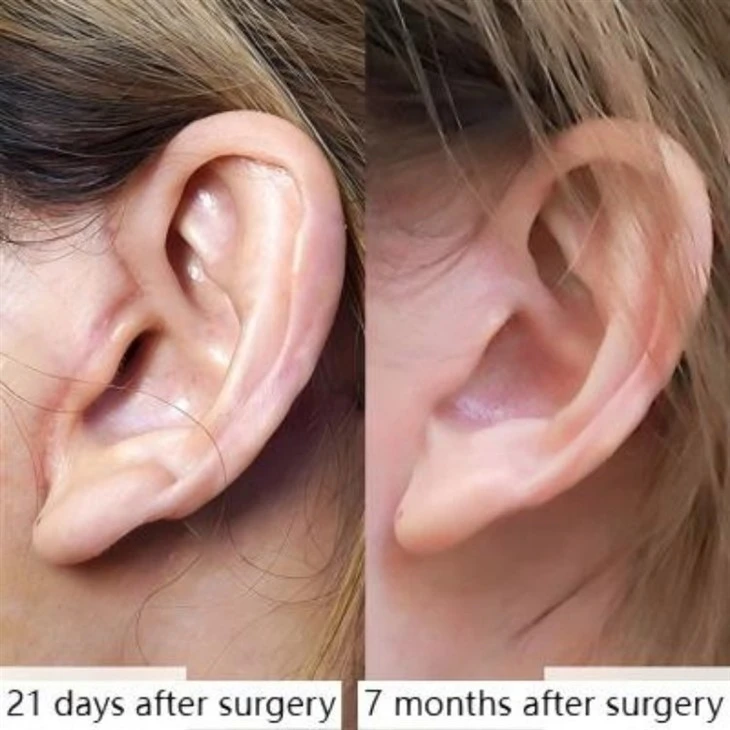 Minimally invasive jawline surgery