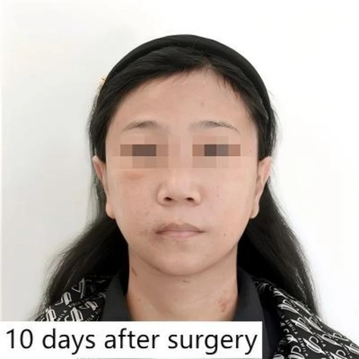 Nasolabial fold improvement price