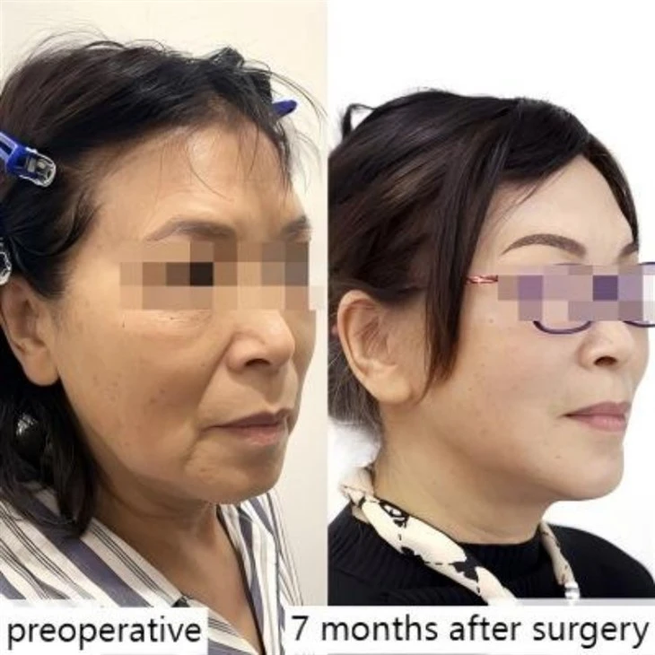 Sagging Chin Repair