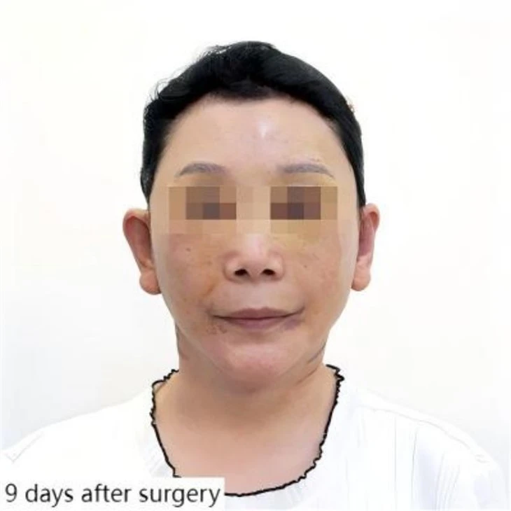 Correction of drooping corners of mouth