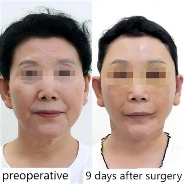 Chirurgie voor hangende mondhoeken