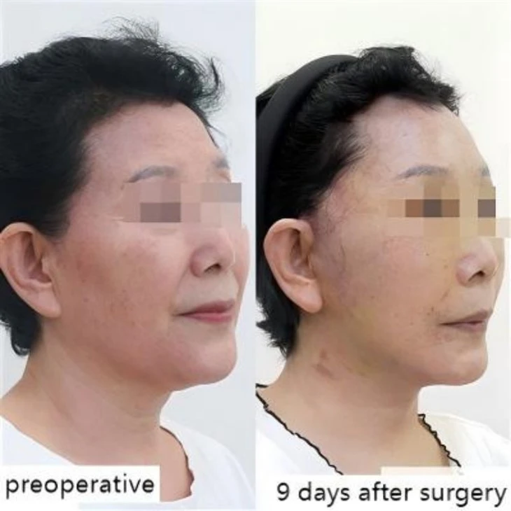 Correction of drooping mouth corners